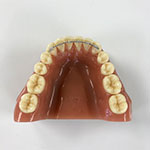 palatal expander