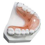 palatal expander