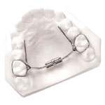 palatal expander